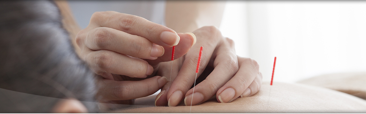 Akupunktur