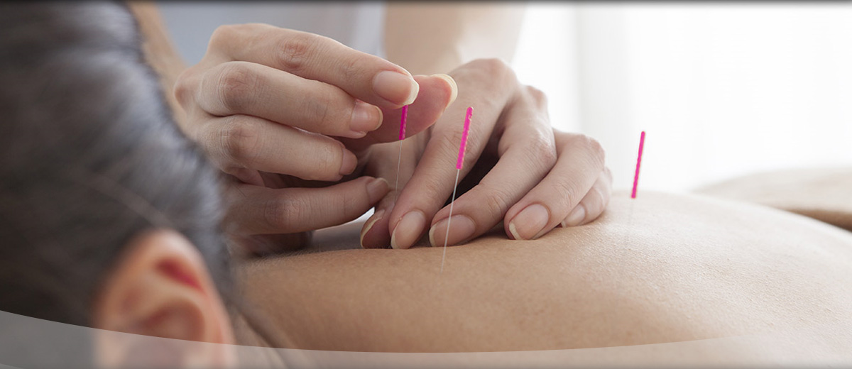 Akupunktur